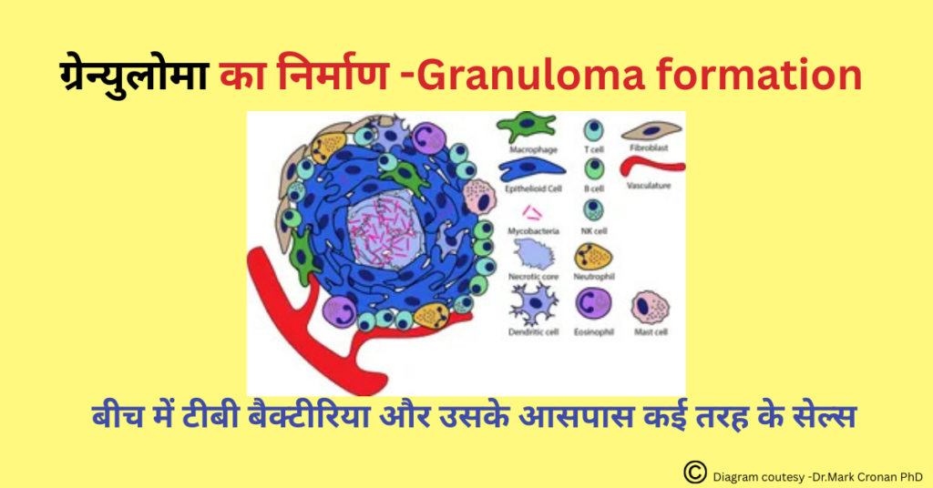 Granuloma